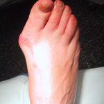 image of a bunion on the right foot