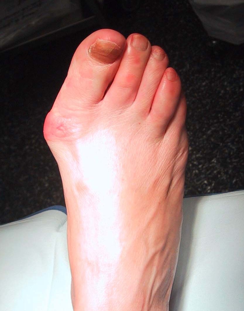 image of a bunion on the right foot
